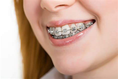 metalicos bracket|precio de bracket dental.